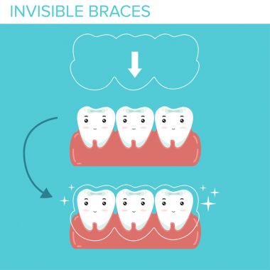 dişleri ile mavi arka plan üzerinde görünmez diş telleri