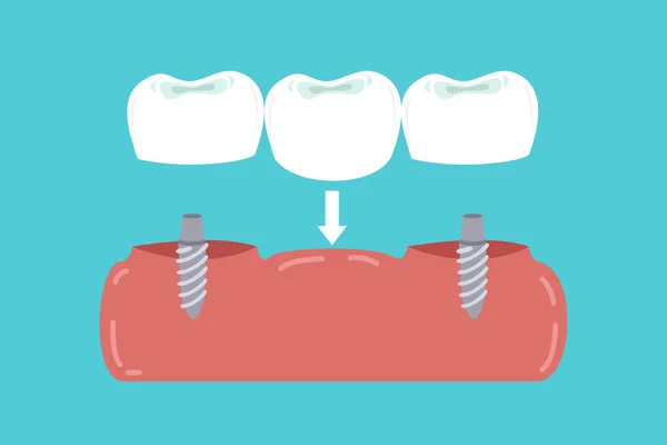 Implantátumok Íny Támogatott Fogászati Híd — Stock Vector