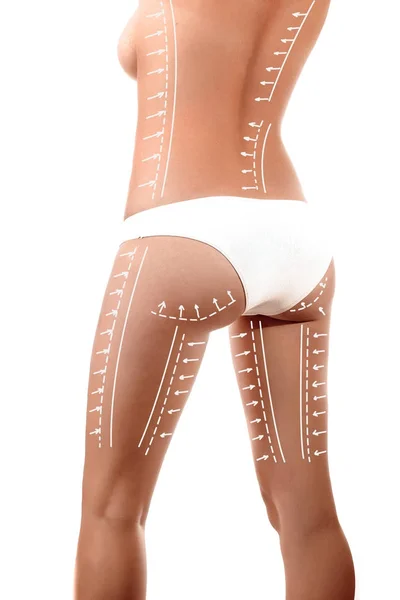 Cuerpo femenino con líneas estampadas y flechas en él, aislado en blanco. El concepto de cirugía plástica, eliminación de grasa, liposucción y celulitis . —  Fotos de Stock