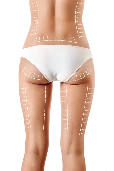 Corpo feminino com linhas padronizadas e setas sobre ele, isolado em branco. O conceito de cirurgia plástica, remoção de gordura, lipoaspiração e celulite . — Fotografia de Stock