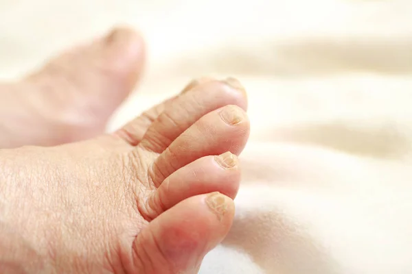 Oude man blote voeten met droge huid en nagels — Stockfoto