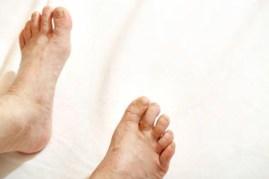 yaşlı adam kuru cilt ve çivi ile yalınayak