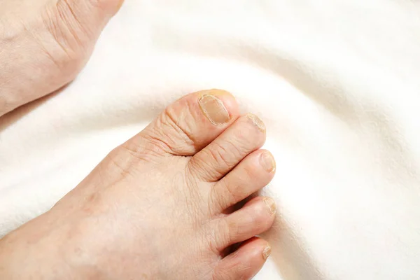 Vieil homme pieds nus avec peau sèche et ongles — Photo