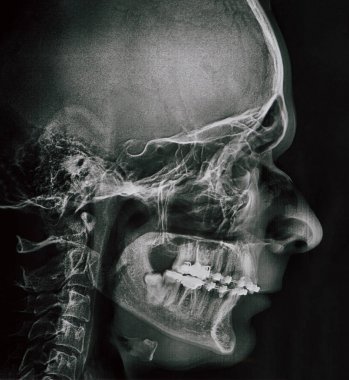 Adam çene profili xray