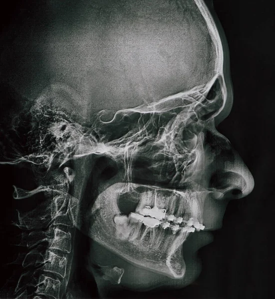Profile xray of man jaw — Stock Photo, Image