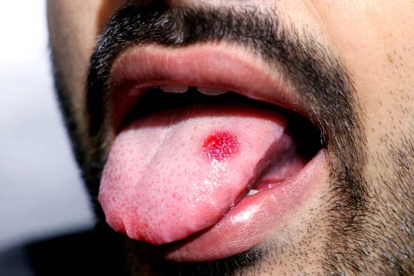 红斑一种有病的舌头的特写 其上有红斑舌头灼伤和不适 — 图库照片