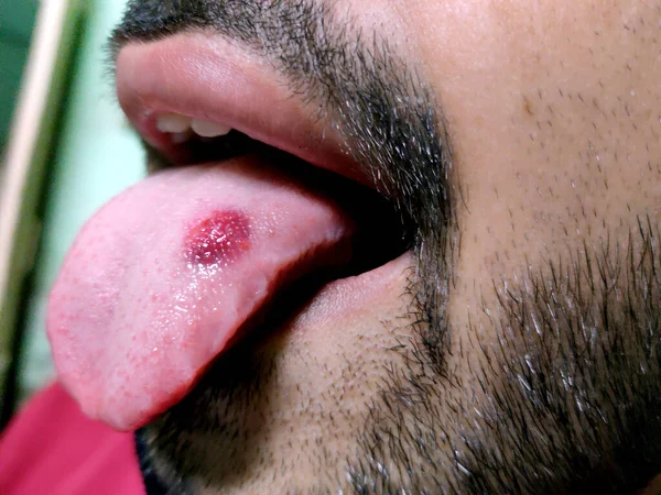 Kırmızı Bir Noktanın Parladığı Hastalıklı Bir Dilin Yakın Çekimi Dilin — Stok fotoğraf