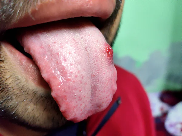 Close Uma Língua Doente Que Ponto Vermelho Brilha Queima Desconforto — Fotografia de Stock