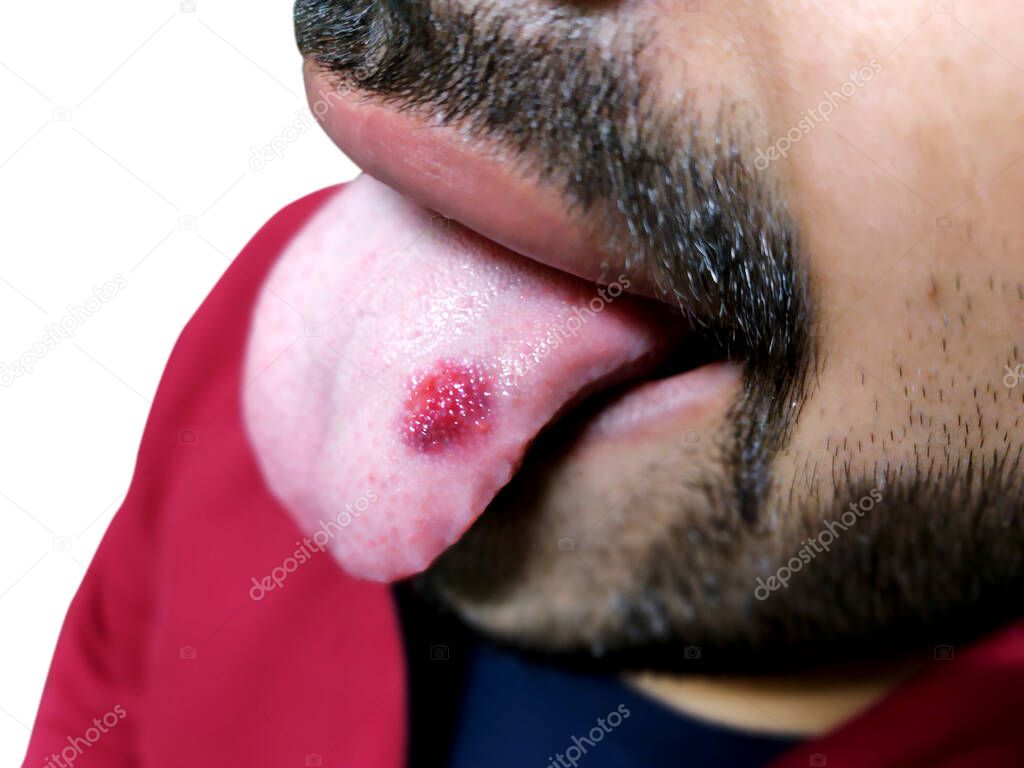 A closeup of a diseased tongue in which a red spot glosses. Burning and discomfort of the tongue