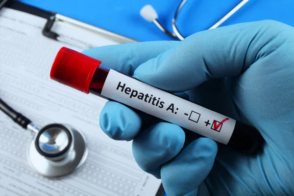 Hepatit A için kan testi. Kanlı vakum tüpü. Mavi arkaplan.