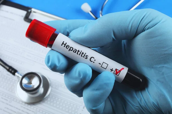 Hepatit C için kan testi. Kanlı vakum tüpü. Mavi arkaplan.