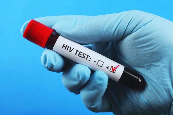 Doktorun elinde kan olan vakum test tüpü. Hepatit için kan testi. Mavi arkaplan.