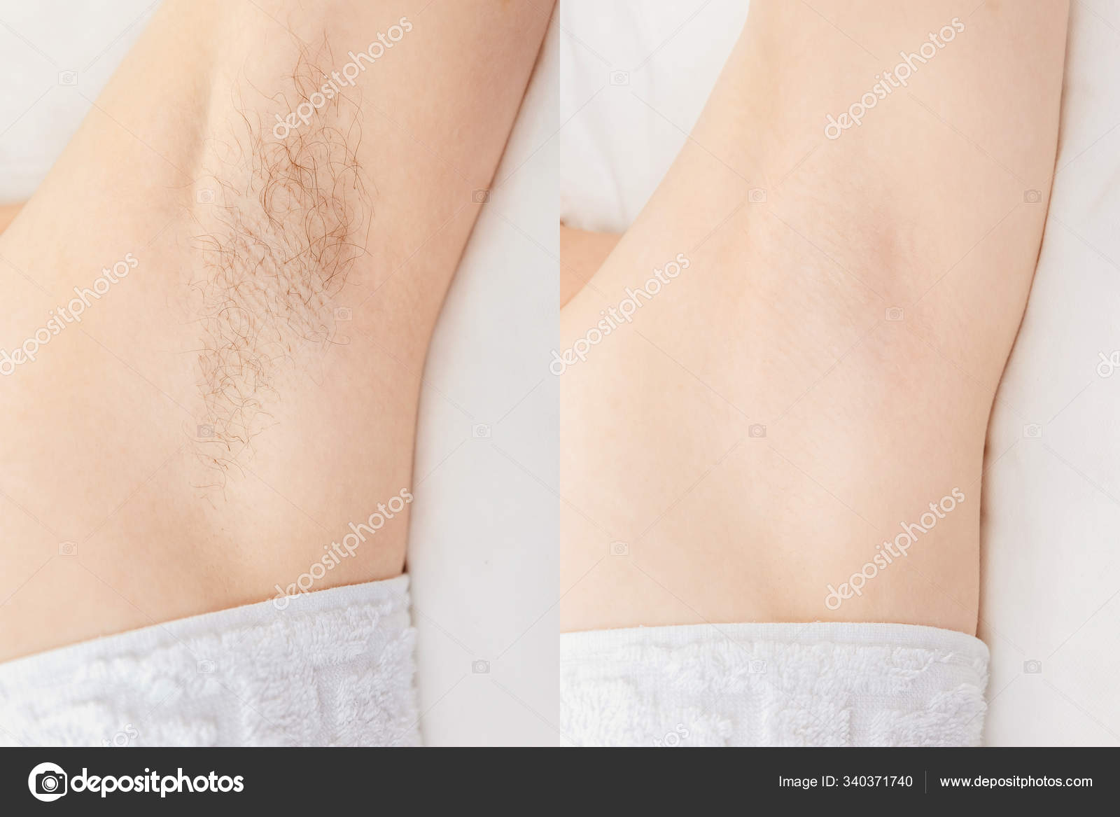 Women underarm hair removal. Concept before and after shaving sugar  depilation laser Stock Photo by ©ParStud 340371740