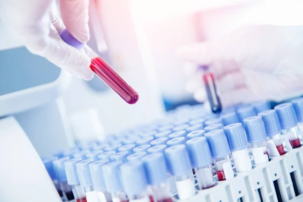 Trabajador de laboratorio preparando sangre para la detección de anticuerpos e infecciones virus Corona — Foto de Stock