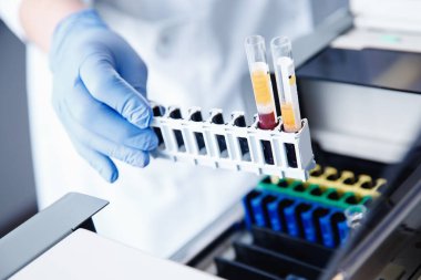 Hemşire mikrobiyolog, Coronavirus 2019 nCoV analizi için kanla test tüpü tutuyor.