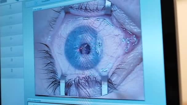レーザービジョン補正 眼科手術中の手術室の患者と外科医 目を開けて滅菌カバーの下で患者 — ストック動画