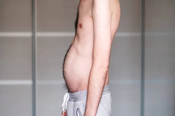 Distrofia muscular de un hombre con una protrusión del abdomen —  Fotos de Stock