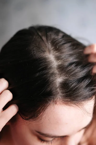 Dandruff on the girls head, diseases of the scalp — Stock Photo, Image
