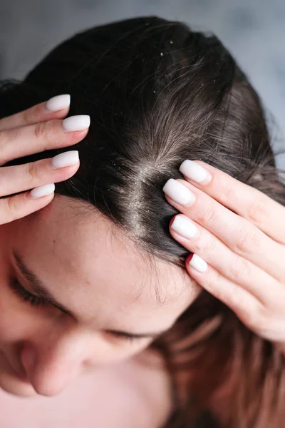 Roos op het hoofd van de meisjes, ziekten van de hoofdhuid — Stockfoto