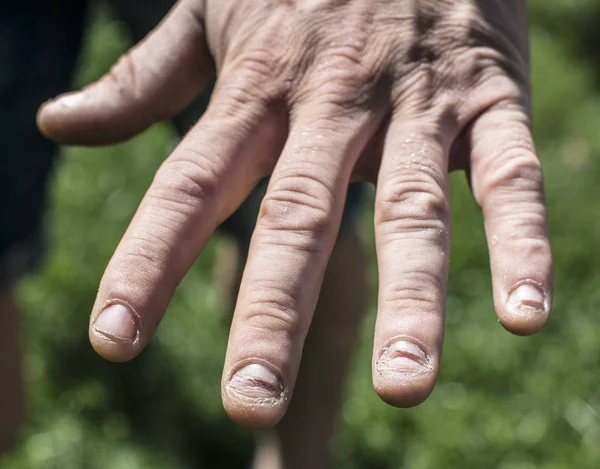 남자에 아픈 손톱, 손을 — 스톡 사진