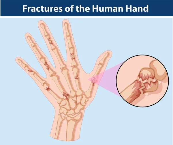 Schema delle fratture nella mano umana — Vettoriale Stock