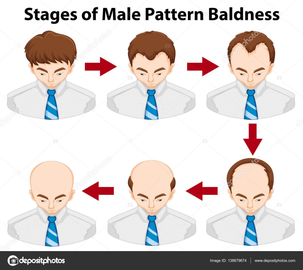 Diagram showing stages of male pattern baldness Stock Vector Image by