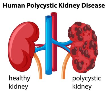 Diagram showing human polycystic kidney disease clipart