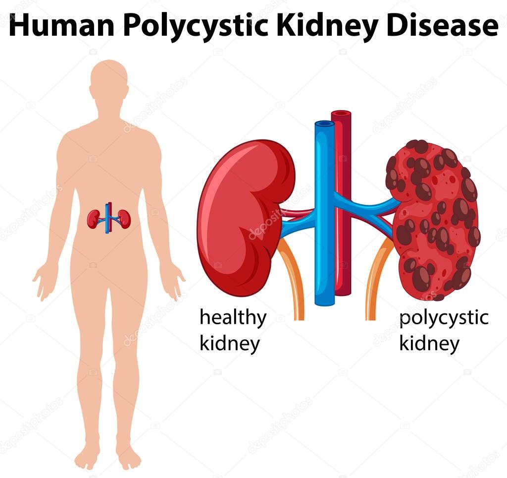 Diagram showing human polycystic kidney disease