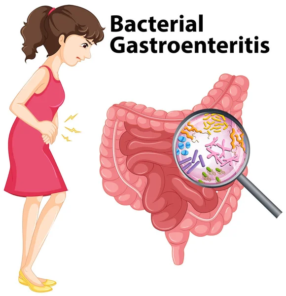 Ábra mutatja a bakteriális gastroenteritis az emberi — Stock Vector