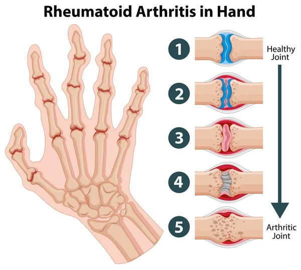 Diagrammet visar reumatoid arthriitis i hand — Stock vektor