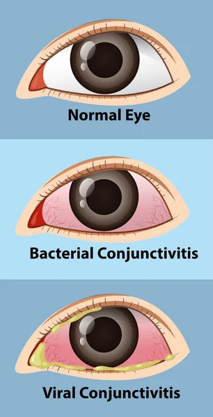 Различные стадии конъюнктивита в глазах человека — стоковый вектор
