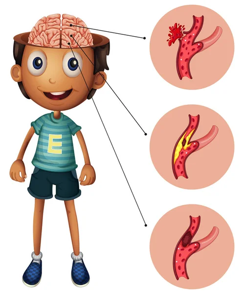 Niño y cerebro con derrames cerebrales — Vector de stock