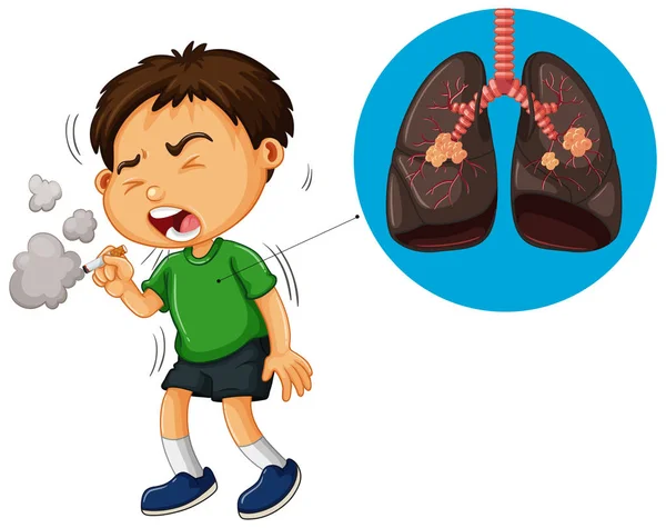 Мальчик курит сигареты и диаграмма нездоровых легких — стоковый вектор