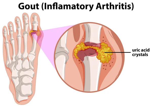 Diagram showing gout in human foot — Stock Vector