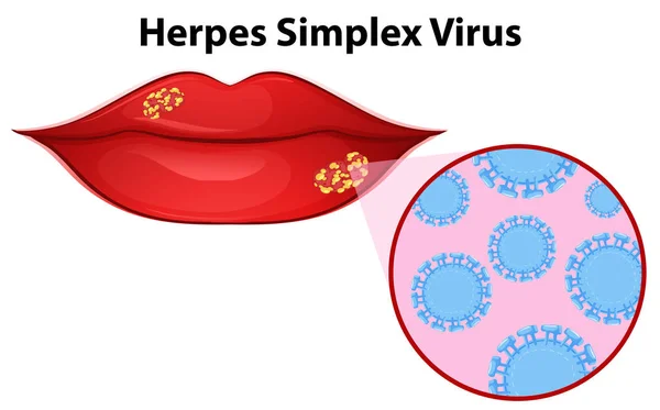 Diagram showing herpes simplex virus — Stock Vector