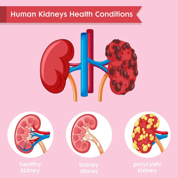 Ilustração médica científica da doença renal — Vetor de Stock