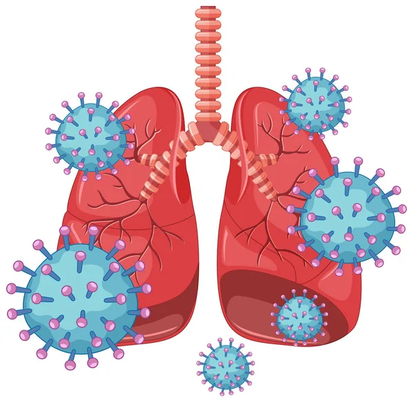 Coronavirus Plakatentwurf Mit Menschlicher Lunge Mit Viruszellen Illustration — Stockvektor