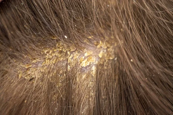 Dandruff in the hair. Flaky scalp. Seborrhea. — Stock Photo, Image