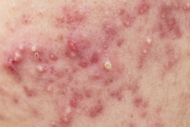       Akne yüz derisinin, dermatolojik hastalığı akne üzerinde