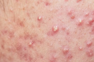 Akne yüz derisinin, dermatolojik hastalığı akne üzerinde