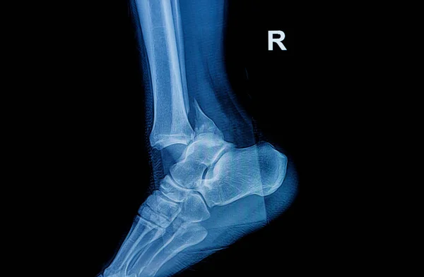 Fracture ankle fibula bone ( leg bone ) X-ray of leg side and vi — Stock Photo, Image