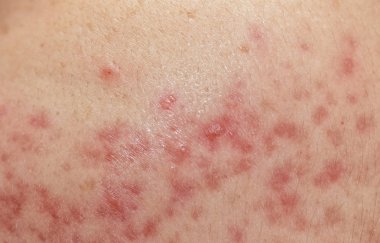closeup skin problems, nodular cystic acne skin clipart