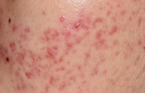 Problemas cutáneos de primer plano, acné quístico nodular piel —  Fotos de Stock