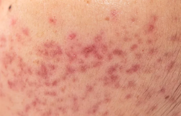 Closeup skin problems, nodular cystic acne skin — Stock Photo, Image