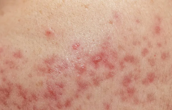 Problemas de pele close-up, pele cística nodular acne — Fotografia de Stock