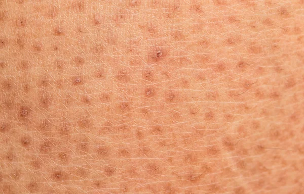 Primer plano del problema de la piel, ictiosis de piel seca vulgar — Foto de Stock