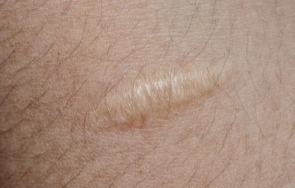 Closeup of keloid scar on skin background — Stock Photo, Image