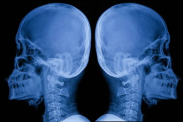 Image of X-ray Asian human skull (LAT view) — Stock Photo, Image