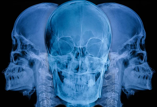 Imagem do crânio humano de raios-X (AP, LAT view ) — Fotografia de Stock