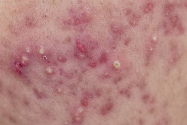Akne yüz derisinin, dermatolojik hastalığı akne üzerinde